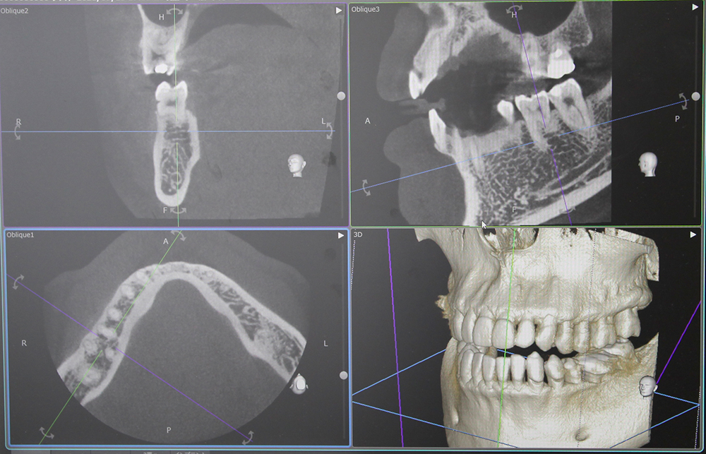 歯科用CT レントゲン画像